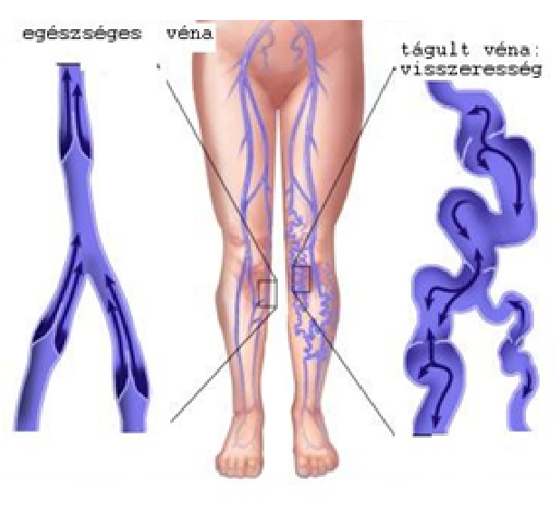 A lábak és a vörös foltok duzzadnak - Thrombophlebitis - November
